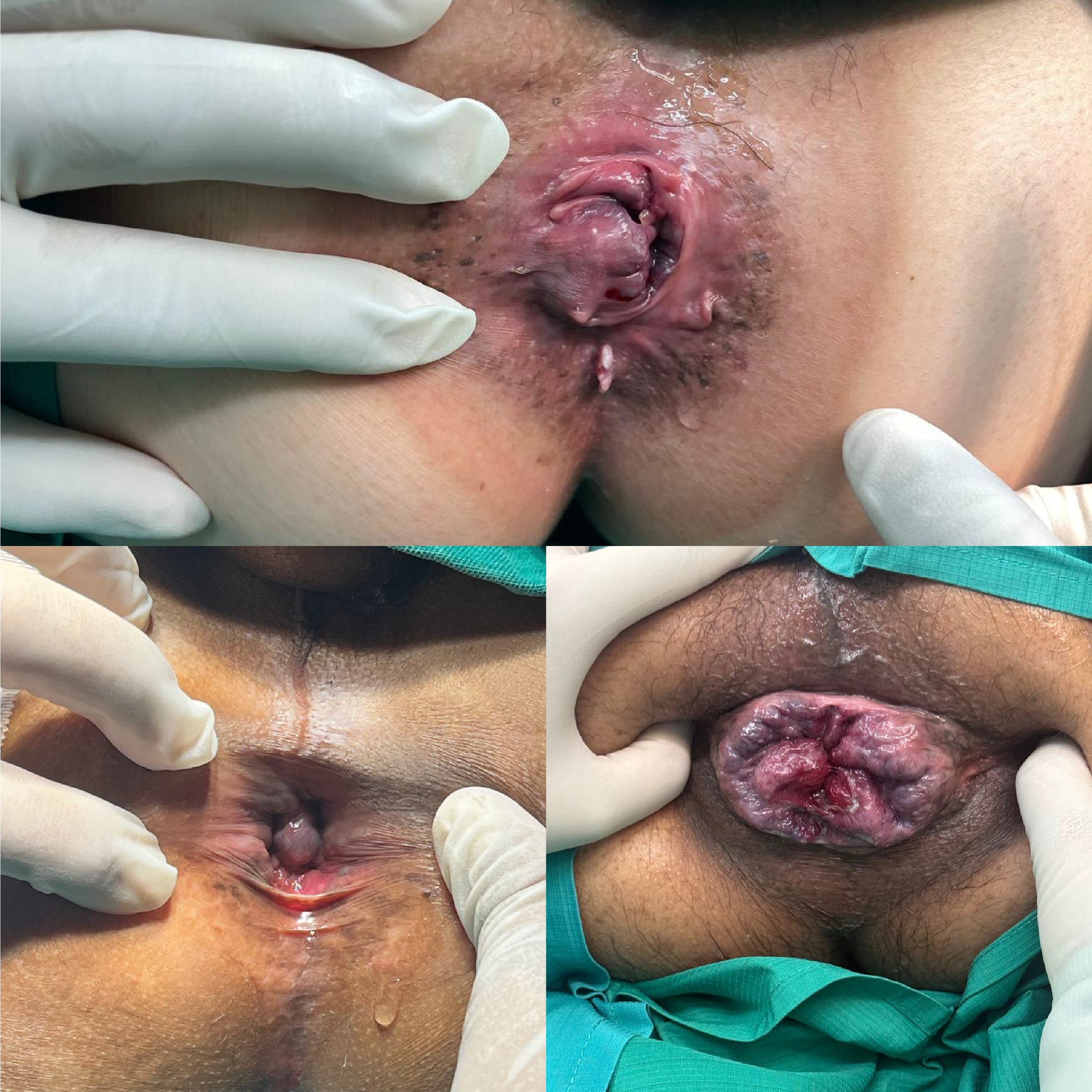 Dr. César Rojas, Hemorroides internas