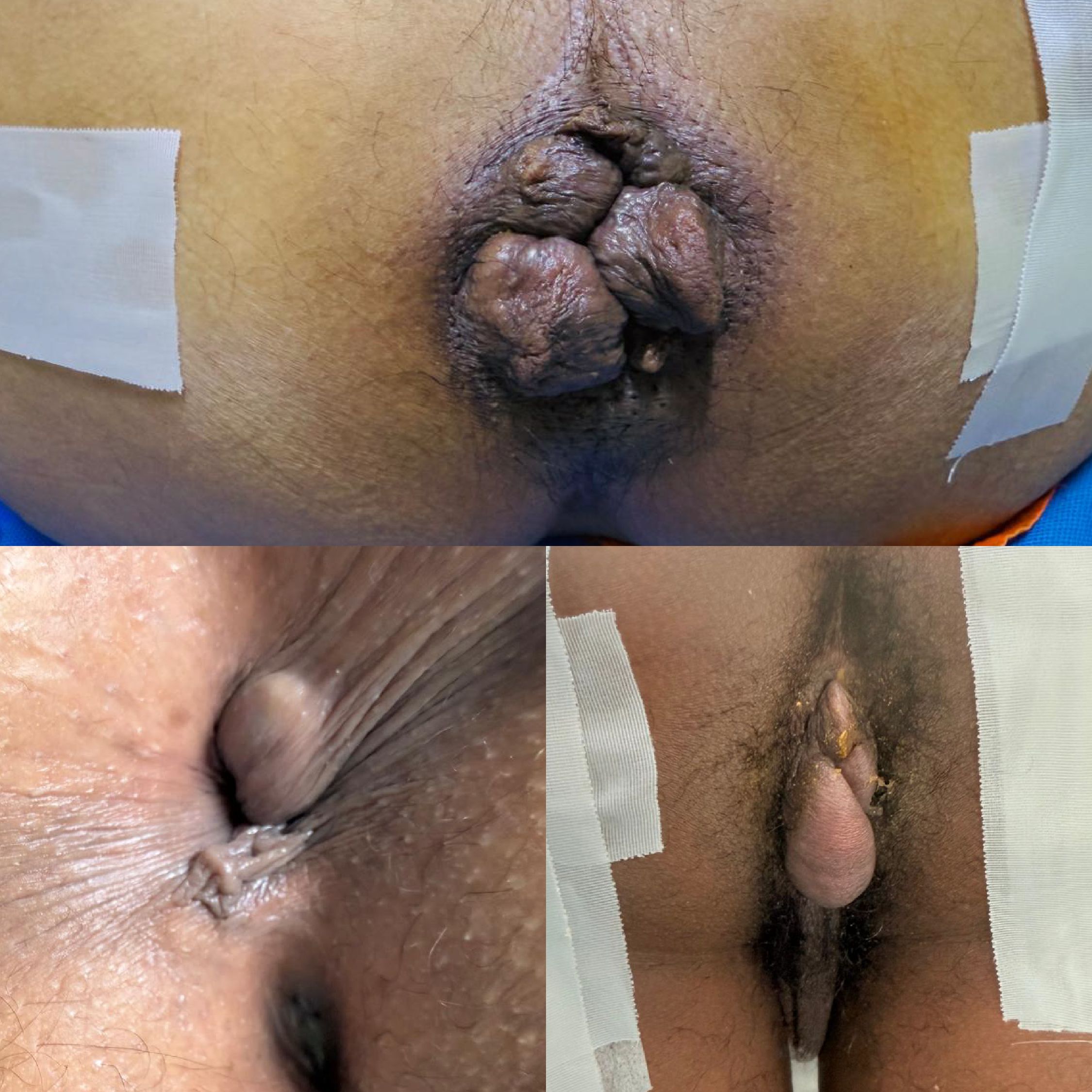 Dr. Cesar Rojas, Hemorroides externas
